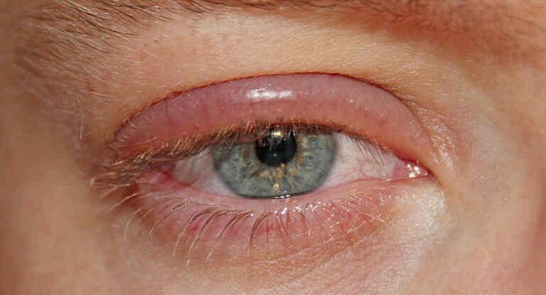Demodectic mange of the eyelids